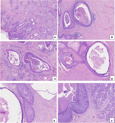 Diagnostic validity of p16, E-cadherin, cyclin D1, p53, and HPV E6/E7 mRNA in CIN 3-like squamous cell carcinoma of the cervix